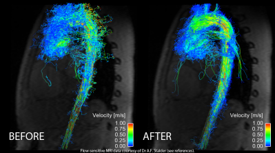 enhancement of blood flow visualization in the aorta, data courtesy of Dr A.F. Stalder